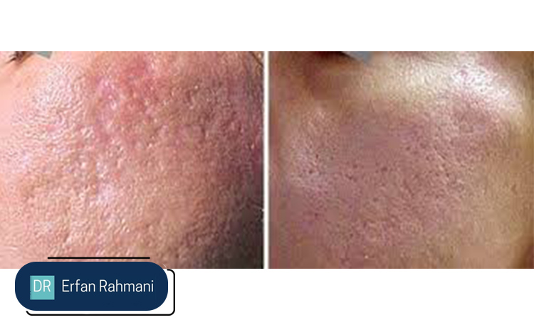 Acne Scar Treatment with Fotona