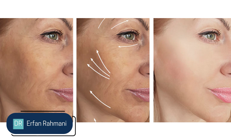 Biostimulators vs. Fillers