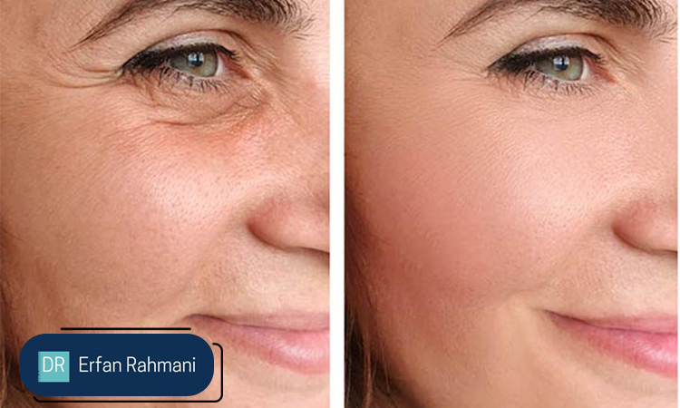 Non Surgical Face Lifting