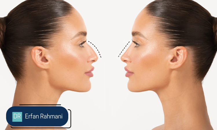 Nose Filler vs Rhinoplasty