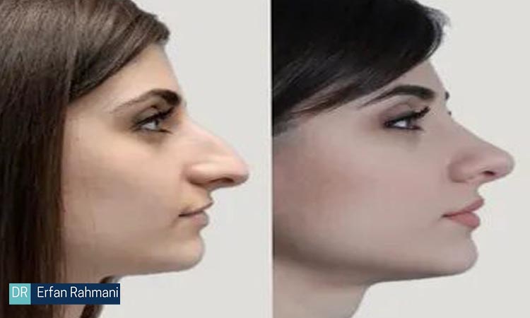 What Is the Best Age for Rhinoplasty?