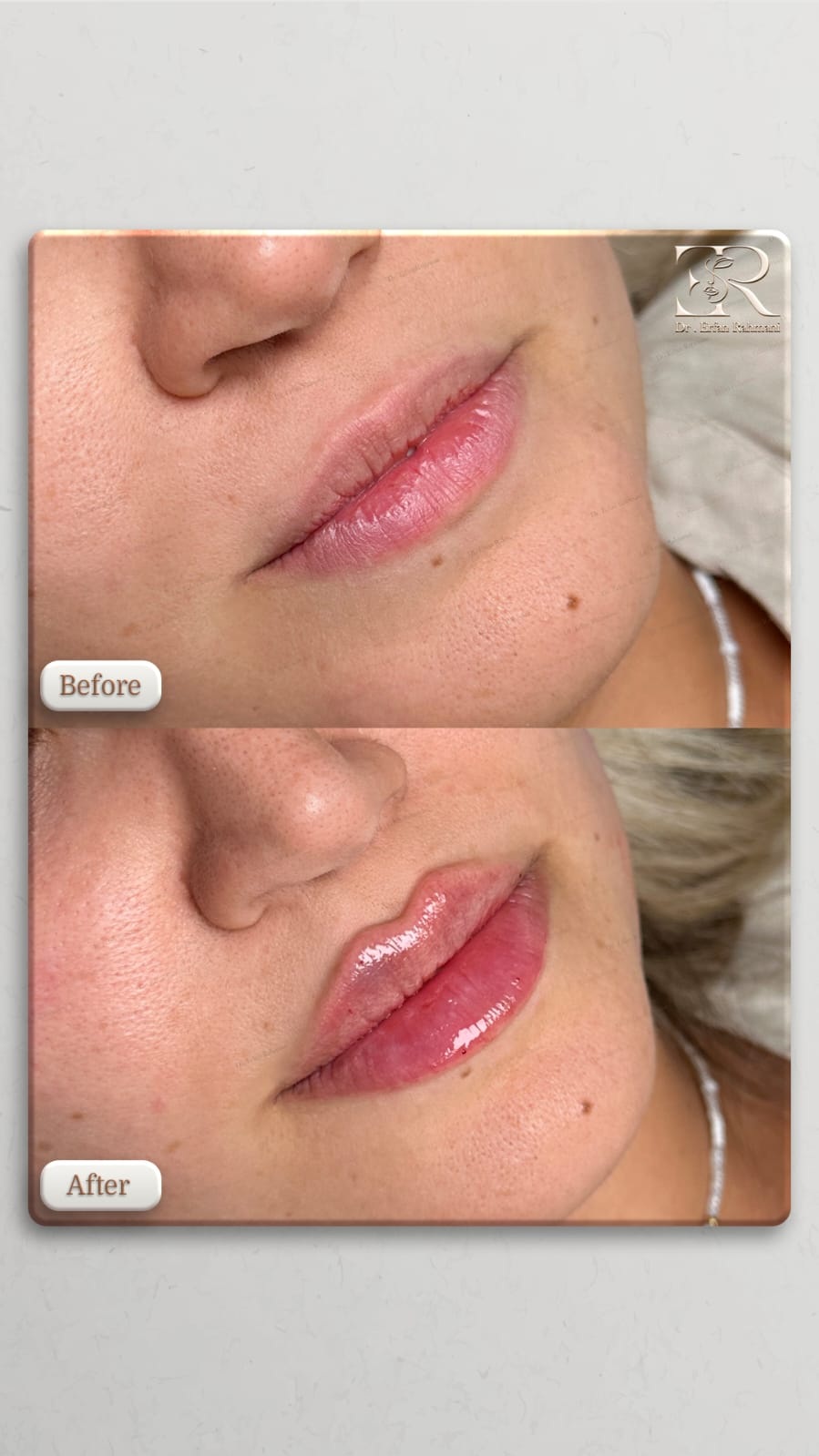 Lip Filler
