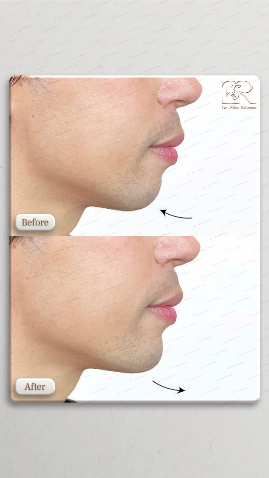 Chin Filler