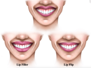 Lip Filler vs Lip Flip