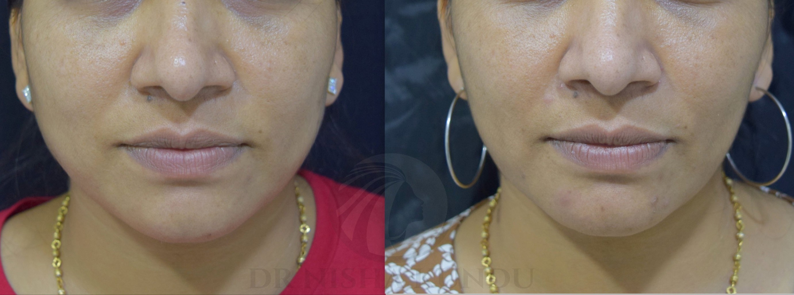 Masseter Botox Abu Dhabi