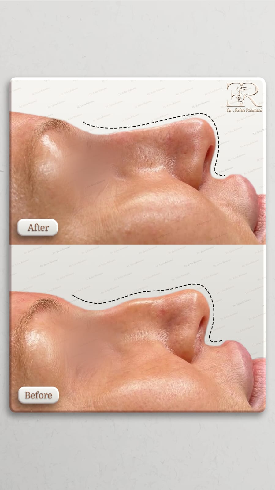 Nose Filler
