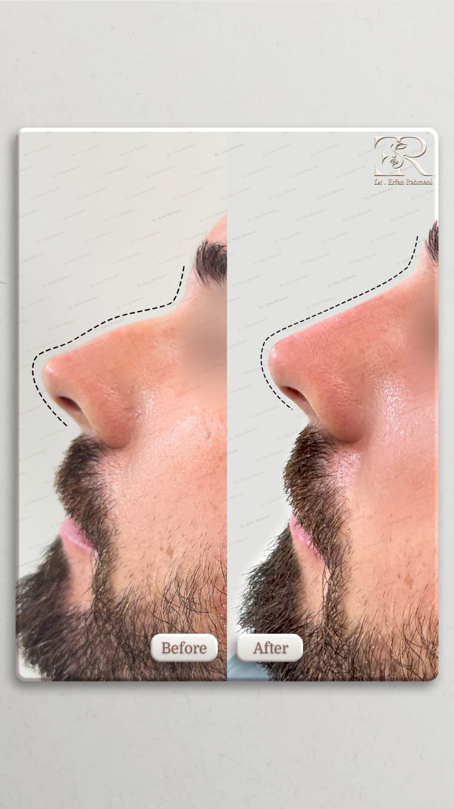 Nose Filler