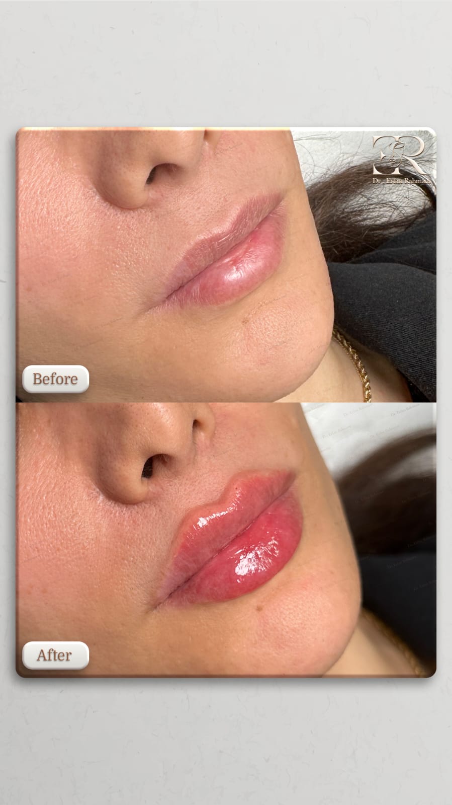 Lip Filler