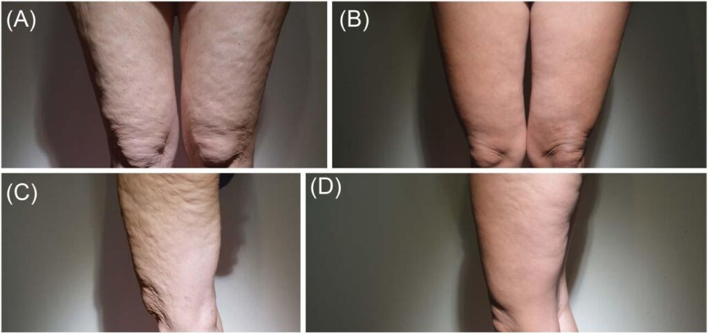 Radiesse skin tightening Abu Dhabi