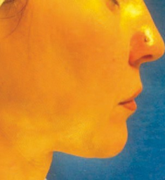 Jawline profile four months after one Endolift pass