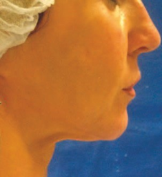 Profile before Endolift 1470 nm laser treatment
