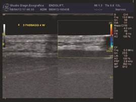 Ultrasound showing Endolift cannula at the deep dermis and superficial fat treatment plane