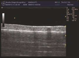 Follow-up ultrasound three weeks after Endolift showing subdermal tissue response