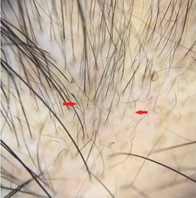 Hair Loss Assessment & Diagnosis Chart