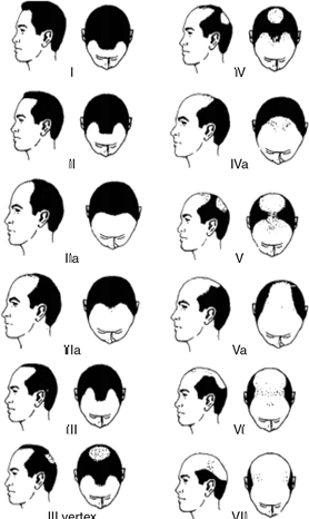 Hair Loss Assessment & Diagnosis Chart