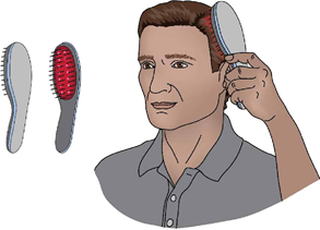Typical male-pattern thinning