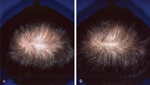 Typical male-pattern thinning