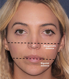 Female face showing bizygomatic and bigonial distance lines