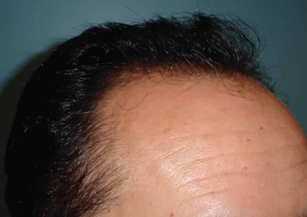 Hair Loss Assessment & Diagnosis Chart