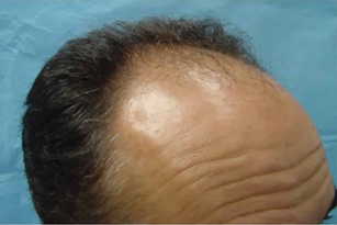Typical male-pattern thinning