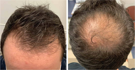Typical male-pattern thinning