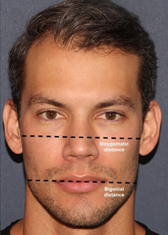 Male face showing bizygomatic and bigonial distance lines