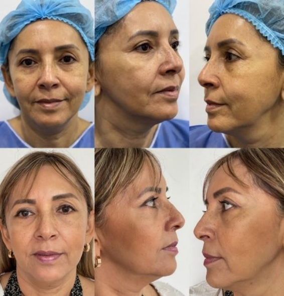 Early cheek and jawline response after Endolift laser, multiple views