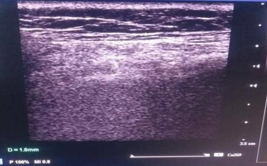 Ultrasound comparison of skin thickness before and after 1470 nm Endolift at day 60