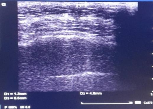 Ultrasound comparison of skin thickness before and after 1470 nm Endolift at day 60