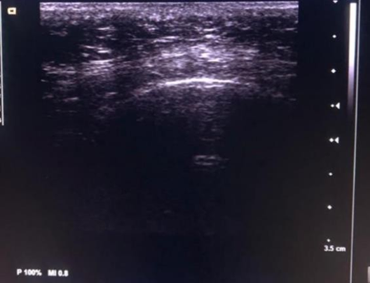 Ultrasound comparison of skin thickness before and after 1470 nm Endolift at day 60