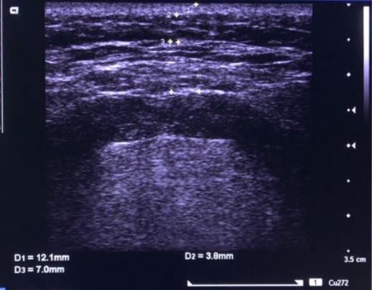 Ultrasound comparison of skin thickness before and after 1470 nm Endolift at day 60