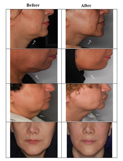 Before and after Endolift jawline and lower face results at three months, from Nilforoushzadeh et al. 2022