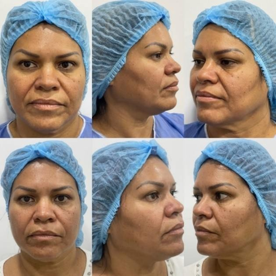 Front and three-quarter facial views before and after Endolift treatment