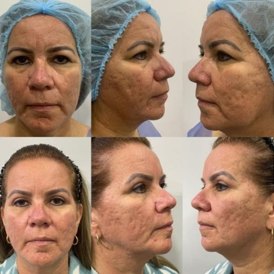 Endolift 1470 nm laser facial photos at day 1 and day 60 showing jawline contour change