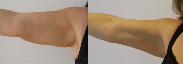 Upper arm skin laxity before and 90 days after HIFU treatment in a published study