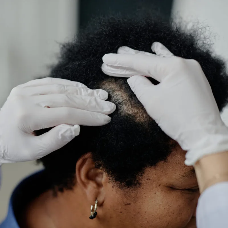 Dermatologist examining scalp for advanced hair loss treatments 2026 consultation