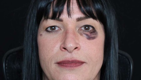 Eye-area bruising after a dermal filler treatment