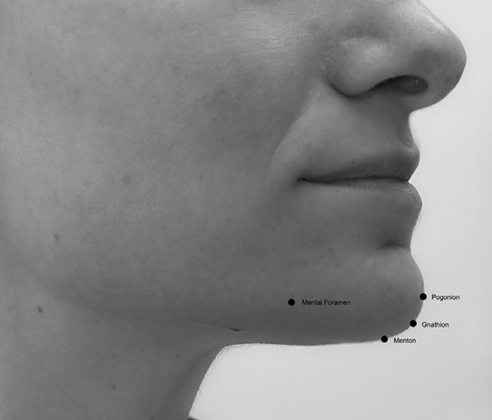 Lateral view of the chin showing anatomical landmarks: mental foramen, pogonion, gnathion and menton