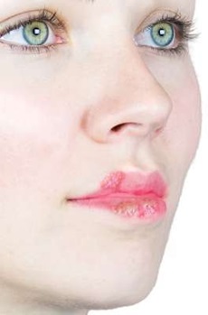 Cold sore on the lip, a herpes simplex outbreak near the mouth