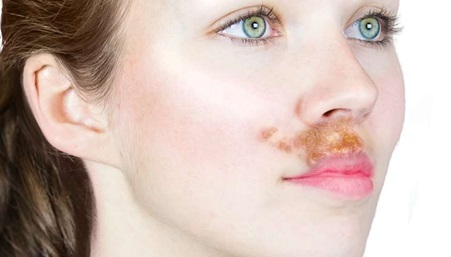 Crusted skin infection around the lips and mouth