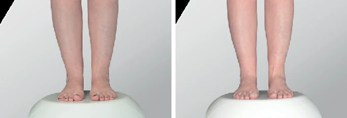 Endolift ankle before and after: front view of the lower legs and ankles with improved contour and tighter skin on the right