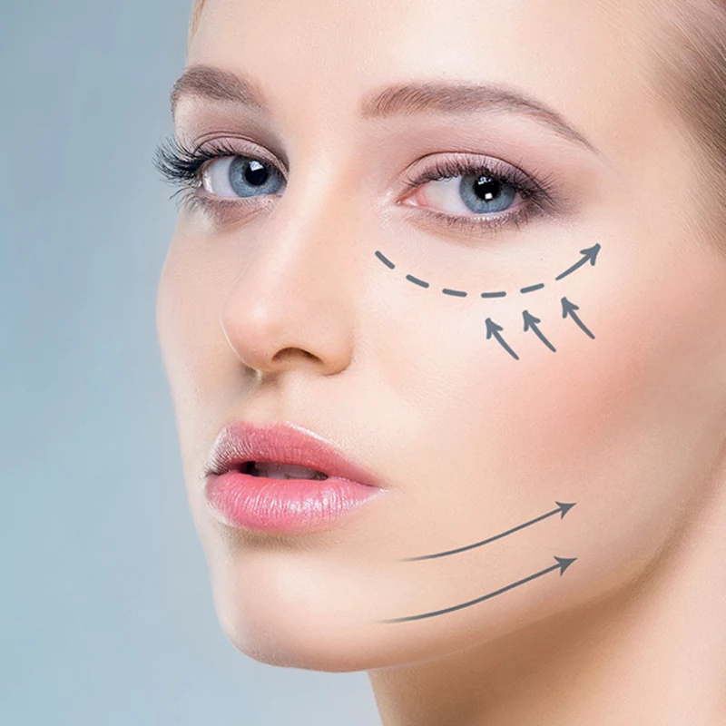 Endolift in Abu Dhabi: arrows on a woman’s face showing anti-gravitational lifting vectors under the eye and along the jawline