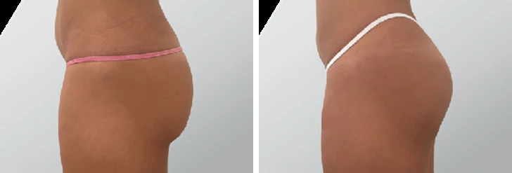 Endolift gluteal contour before and after: side view of the buttock and upper thigh area with smoother, tighter contour on the right