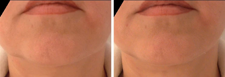Endolift jawline contour before and after: front view of the lower face and chin with improved mandibular definition on the right