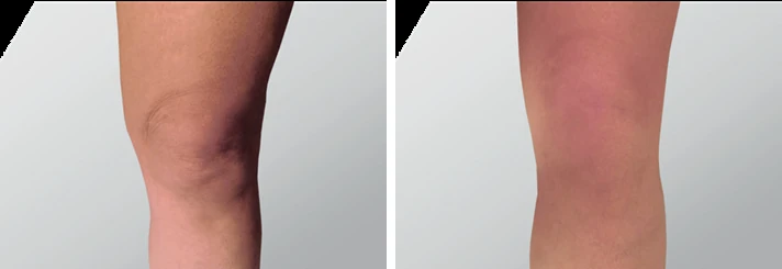 Endolift knee before and after: front view of the knee with loose skin on the left and tighter, smoother skin on the right