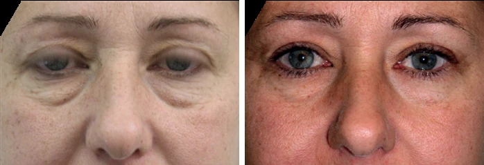 Endolift lower eyelid before and after: under-eye skin laxity on the left and tightened lower eyelids on the right