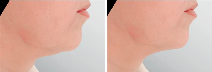Endolift under chin before and after: submental profile with lax skin on the left and a tighter, more defined jawline on the right