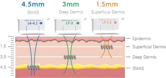 Cross-section diagram of skin showing HIFU focal depths: 1.5 mm superficial dermis, 3.0 mm deep dermis and 4.5 mm SMAS layer