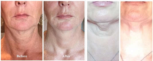 Two before-and-after photo pairs of the lower face and neck with different lighting, shown as an unverified example of HIFU skin tightening results