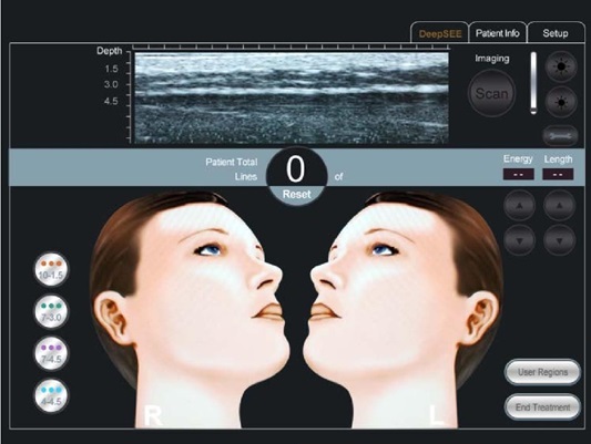 HIFU device control screen showing an ultrasound imaging strip with depth scale, treatment line counter, energy settings and right and left face views